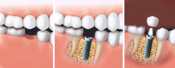 Grafiken zur Veranschaulichung des Einsetzens eines Zahnimplantats